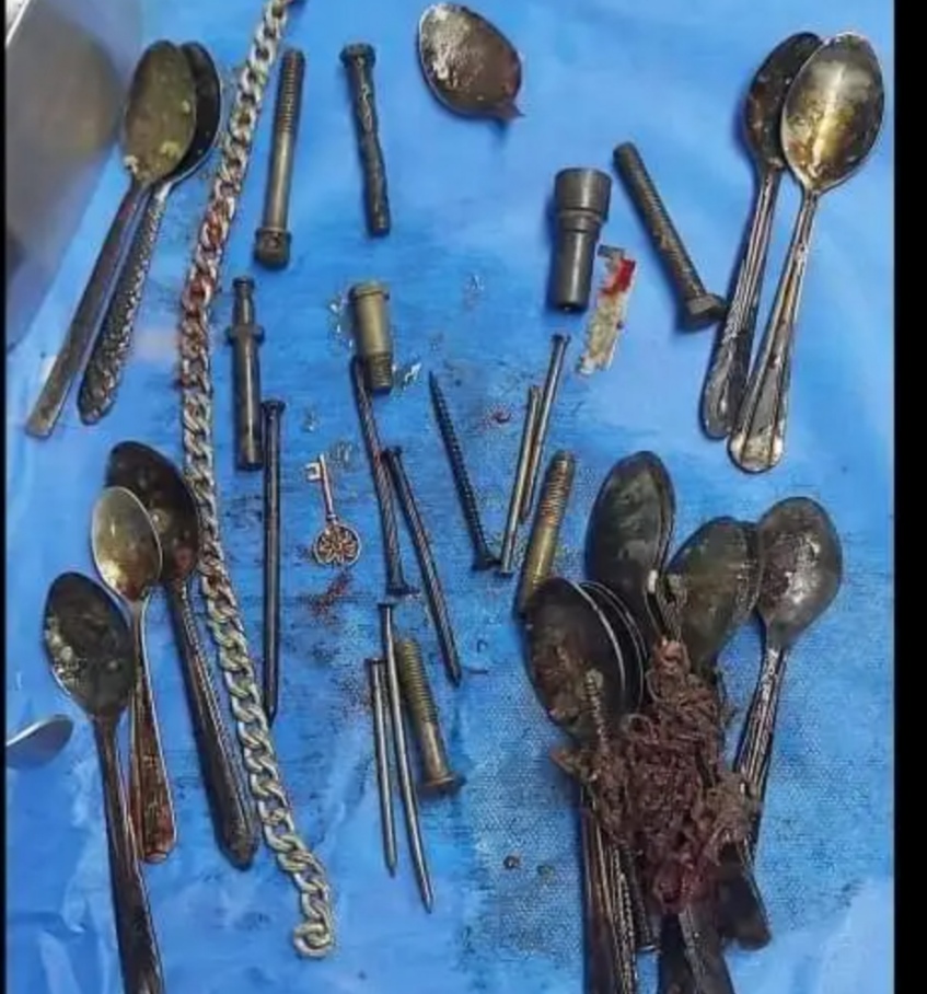 إستخراج 20 معلقة وأمواس ومفاتيح من معدة مريض 30 عاما 2 Screenshot ٢٠٢٤٠١٢٢ ١٣٥٨٥٩
